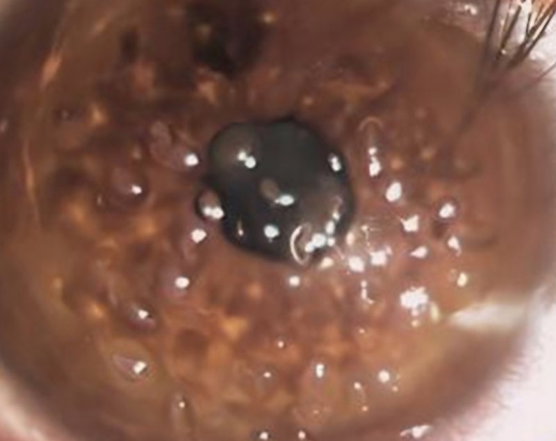 日光強曬海邊嬉戲大學女生   雙眼角膜表面烘成相當罕見的大小氣泡