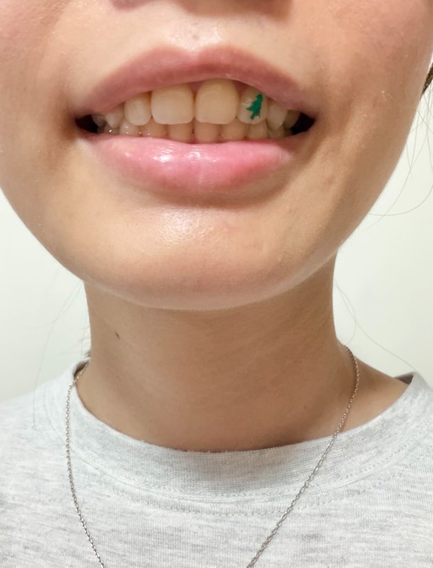 女網友牙齒貼這東西出門　老爸皺眉：怎麼卡那麼大一片菜？