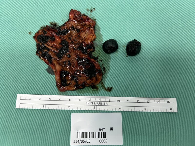 膽結石真會引發膽囊癌！ 全球罕見0.5%癌變機率發生在高雄男身上
