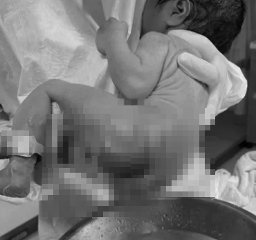 內湖三總出包！母控女兒剛出生洗澡燙傷 「屁股整塊皮掉了」